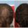 Finasteride Men Here are some results of the use of Finasteride in men.