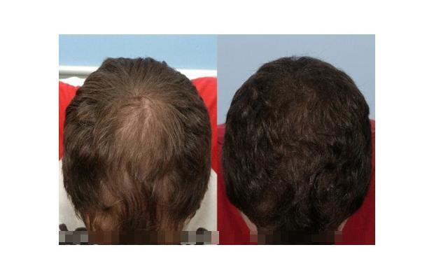 Proscar finasteride)   reviews, ratings, comments by 