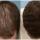 Finasteride Men Here are some results of the use of Finasteride in men.