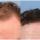 Finasteride Men Here are some results of the use of Finasteride in men.