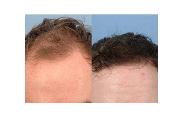 Finasteride Men Here are some results of the use of Finasteride in men.