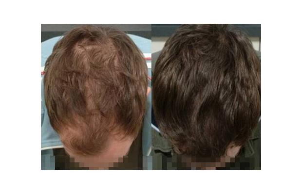 Finasteride Men Here are some results of the use of Finasteride in men.