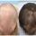 Finasteride Men Here are some results of the use of Finasteride in men.