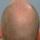 Finasteride Men Here are some results of the use of Finasteride in men.