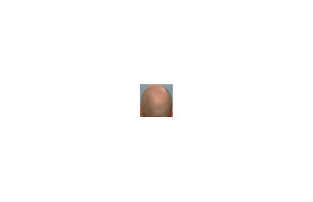 Finasteride Men Here are some results of the use of Finasteride in men.