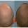 Finasteride Men Here are some results of the use of Finasteride in men.