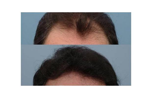 Finasteride Men Here are some results of the use of Finasteride in men.