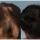Finasteride Men Here are some results of the use of Finasteride in men.