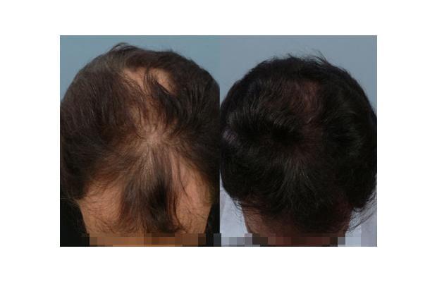Finasteride Men Here are some results of the use of Finasteride in men.