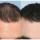 Finasteride Men Here are some results of the use of Finasteride in men.