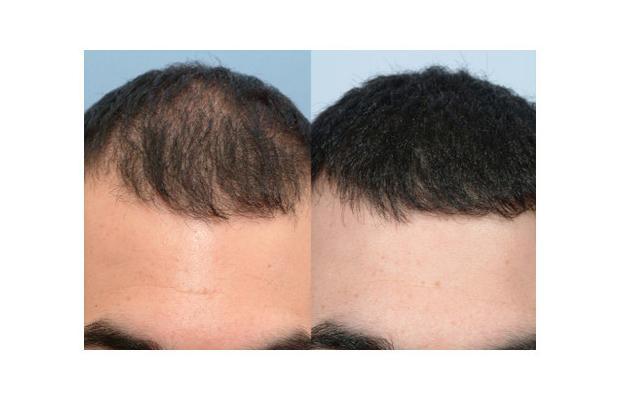 Finasteride Men Here are some results of the use of Finasteride in men.