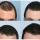 Finasteride Men Here are some results of the use of Finasteride in men.
