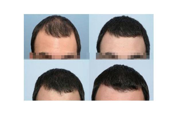 finasteride uses for hair loss