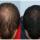 Finasteride Men Here are some results of the use of Finasteride in men.