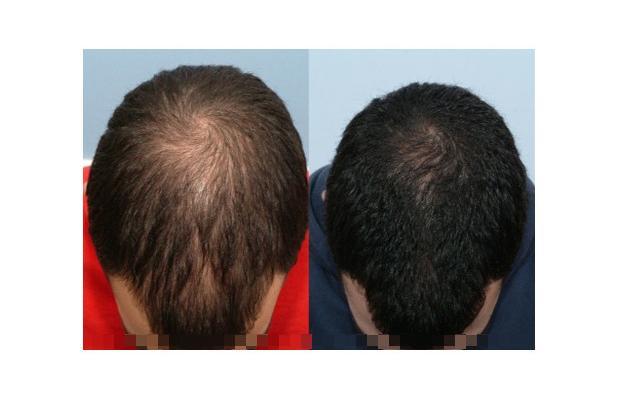 Finasteride Men Here are some results of the use of Finasteride in men.