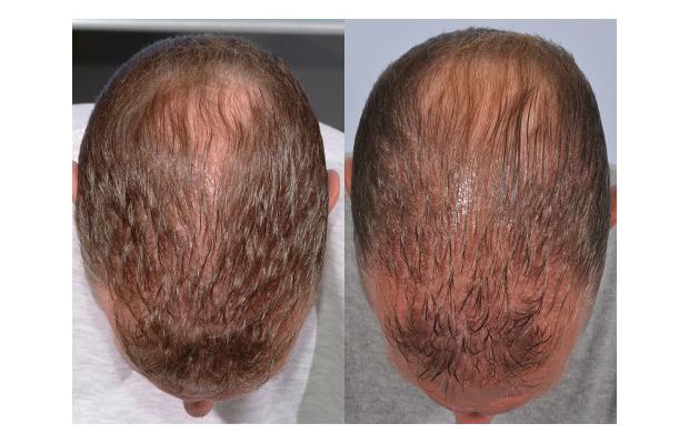 how to use proscar for hair loss