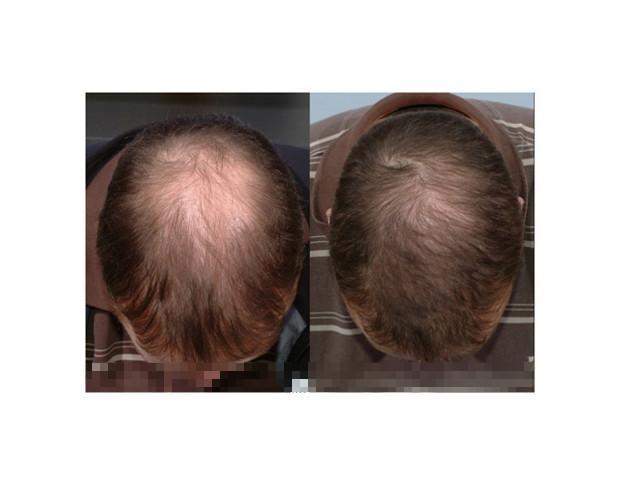 Propecia Results