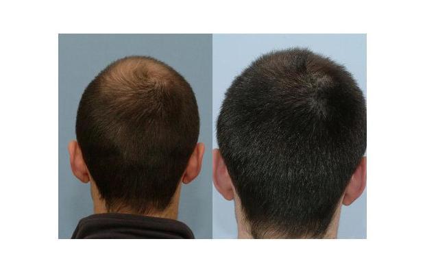 dutasteride hair regrowth results