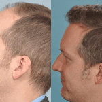 hair-transplant-before-and-after-picture-UK-patient-April-2013