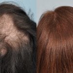hair-transplant-testimonial-uk-patient-jan-2013