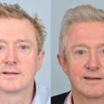 louis-walsh-before-after-testimonial