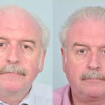 marty_whelan_hair_transplant