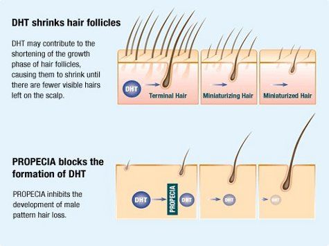 All You Need to Know About DHT and Hair Loss  AHS India