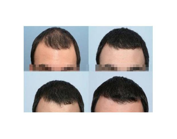 Cheapest Finasteride