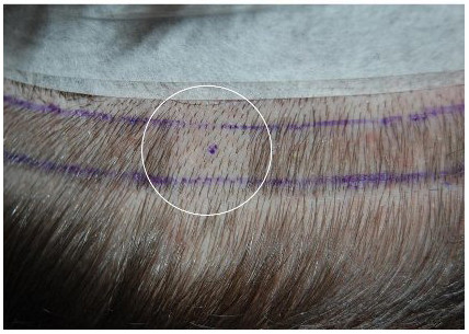 How many hair grafts do I need for my transplant? - HRBR