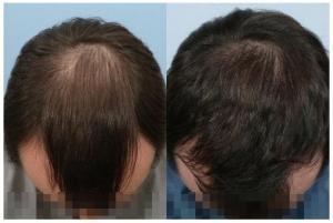 Hair transplant long hair