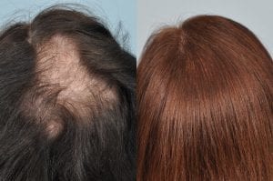 hair transplant long hair