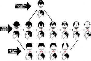 androgenetic alopecia hair classification