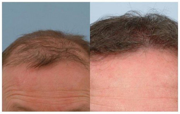 Hair transplant before and after photos