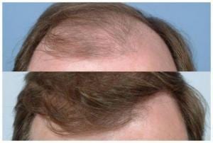 hair-transplant-before-after