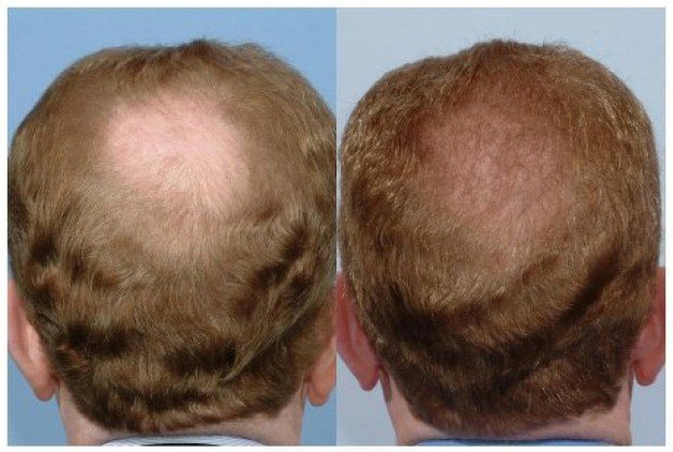 Is There a Link Between Testosterone and Hair Loss  HFS Clinic HGH  TRT