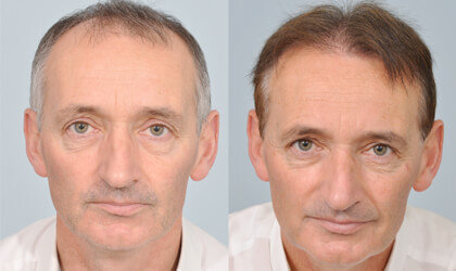 Patrick Nevin HRBR before after