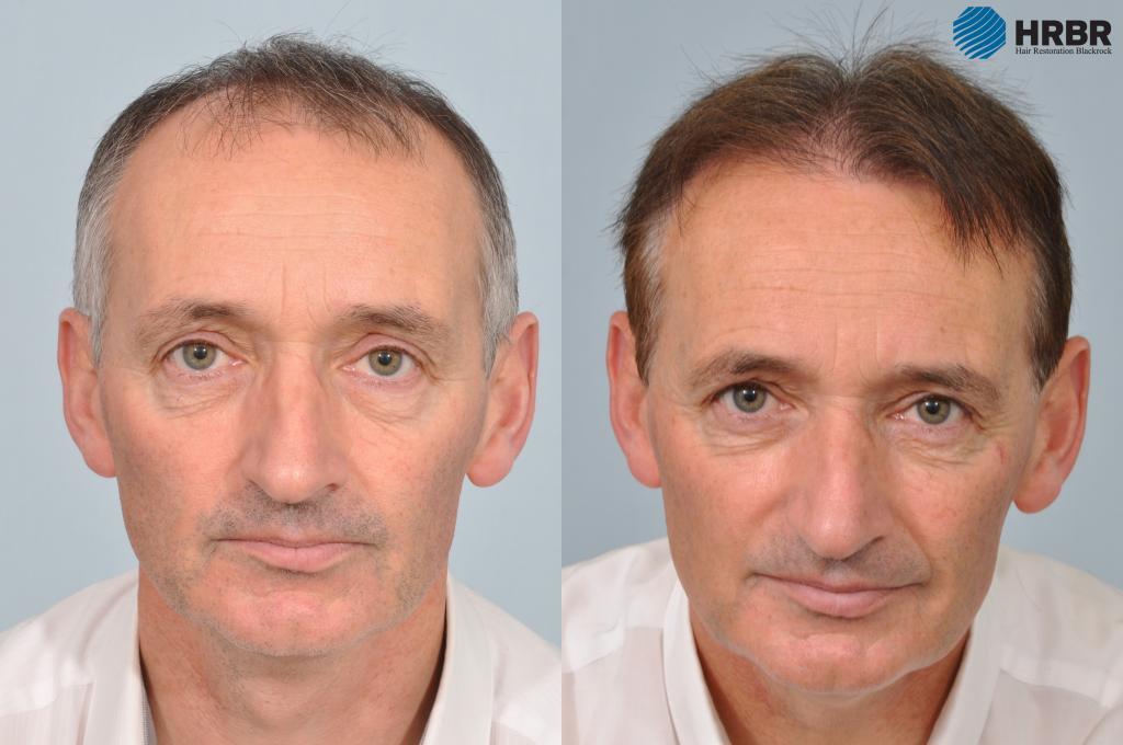 Pat Nevin hair transplant before after