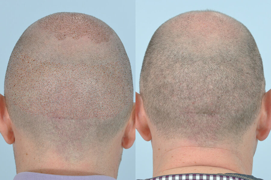 My FUE Hair Transplant 20 days after my 2nd FUE Hair Transplant