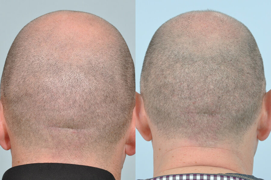 FUE Procedure Hair Transplant Clinic Ireland