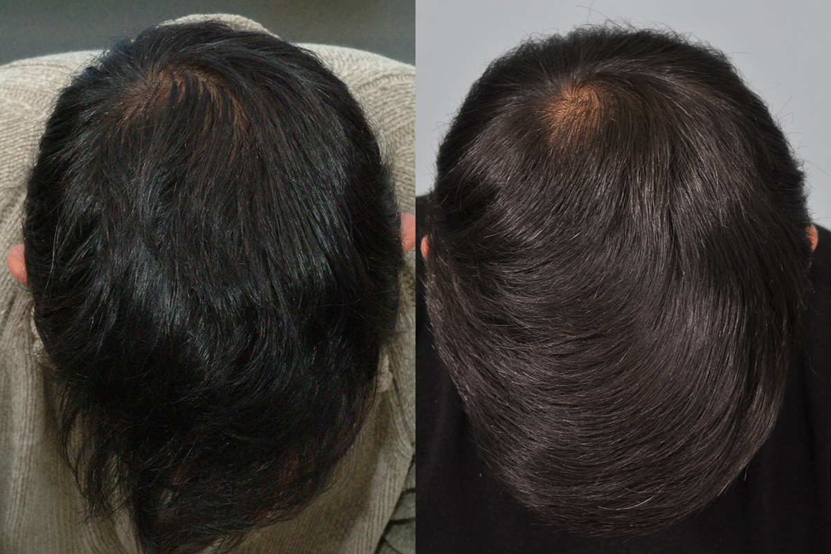 Minoxidil (Regaine) & Finasteride results after 10 years