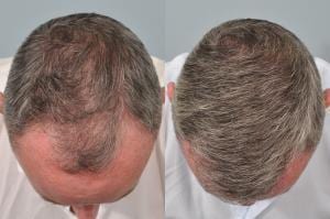 hair transplant 6 months post op before and after