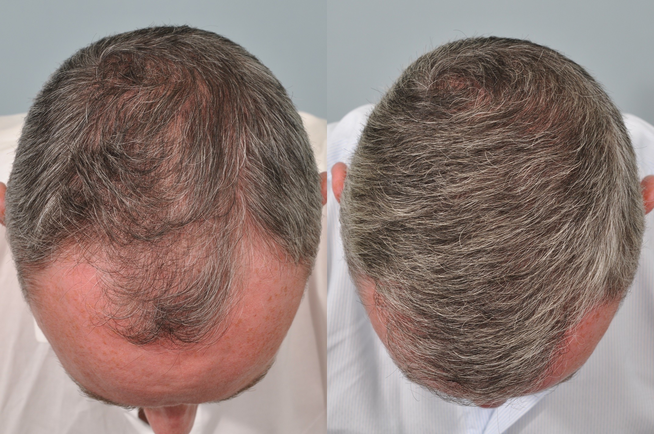 COZMODERM  Before and After one month Results ofAdvanced Hair Transplant  treatment with FUE technique performed at Cozmoderm Clinic by Dr Ankit  Agrawal No Pain No Stitches No Scars  Advanced Hair