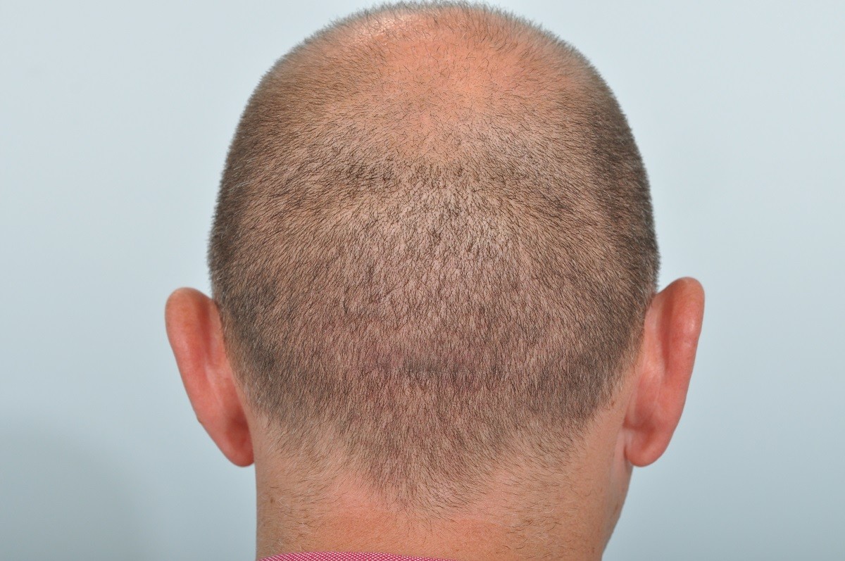 hair transplant scar repair