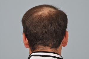 FUT hair transplant Donor Area after surgery