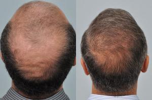 Hair restoration results - crown before and after treatment at HRBR