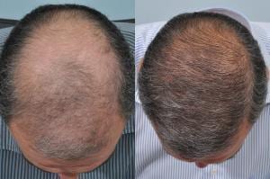 Hair restoration results - before and after treatment at HRBR