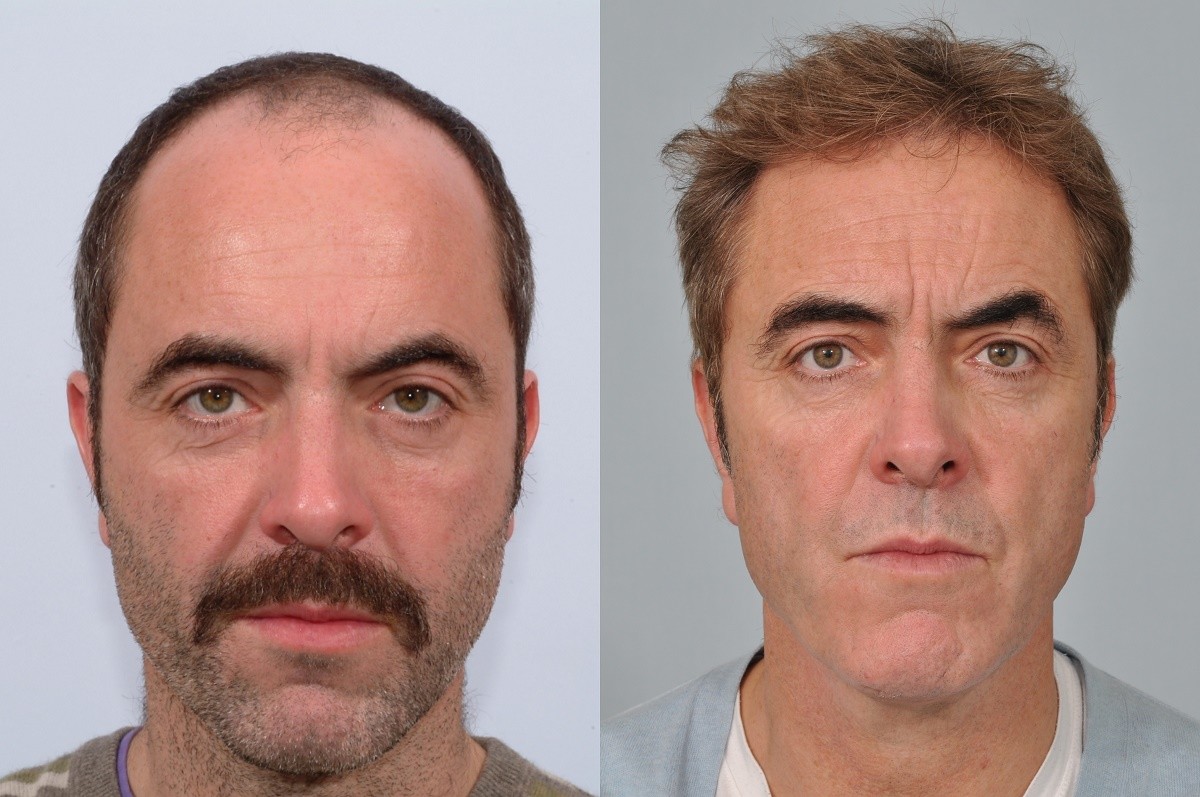 James Nesbitt hair transplant before and after