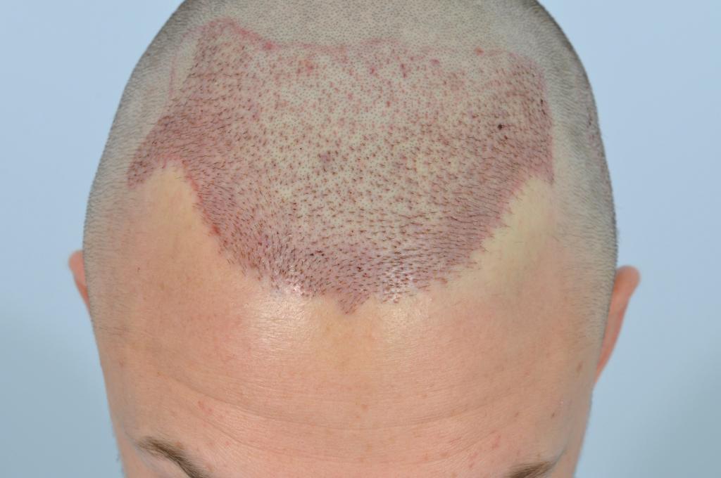 How should a person look immediately after a hair transplant?