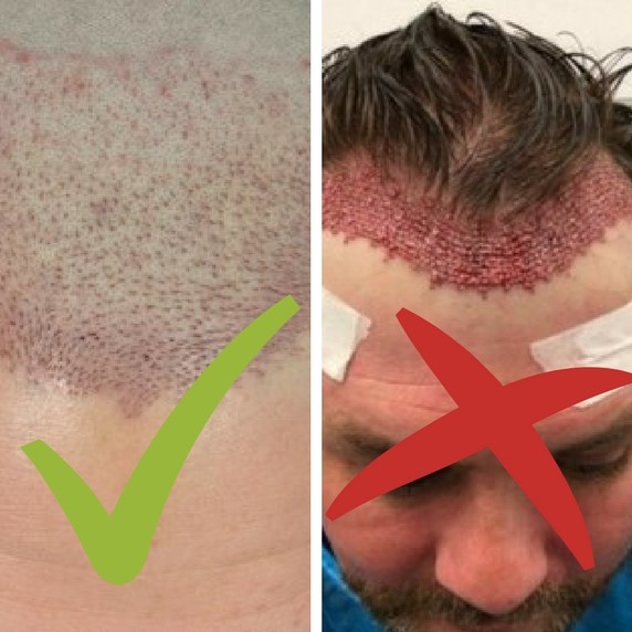 How should a person look immediately after a hair transplant?