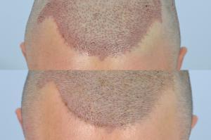 how a hair transplant should look immediately after and the day after surgery